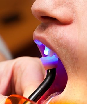 curing light being used on a man to harden bonding
