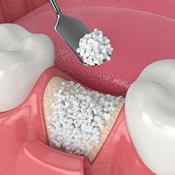 Illustration of granular bone graft at the site of a missing tooth