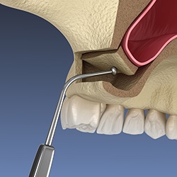 Illustration showing part of sinus lift procedure