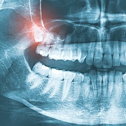 A close-up of an x-ray that highlights wisdom teeth