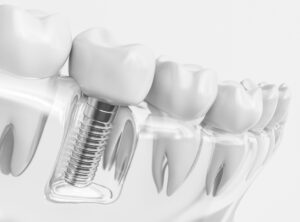 3D rendering of a row of teeth with a dental implant with a white background